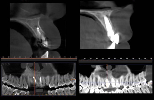 Одномоментная имплантация в Клинике реконструктивной стоматологии