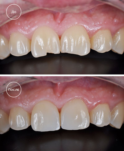 Эстетическая реставрация зубов 6 зубов